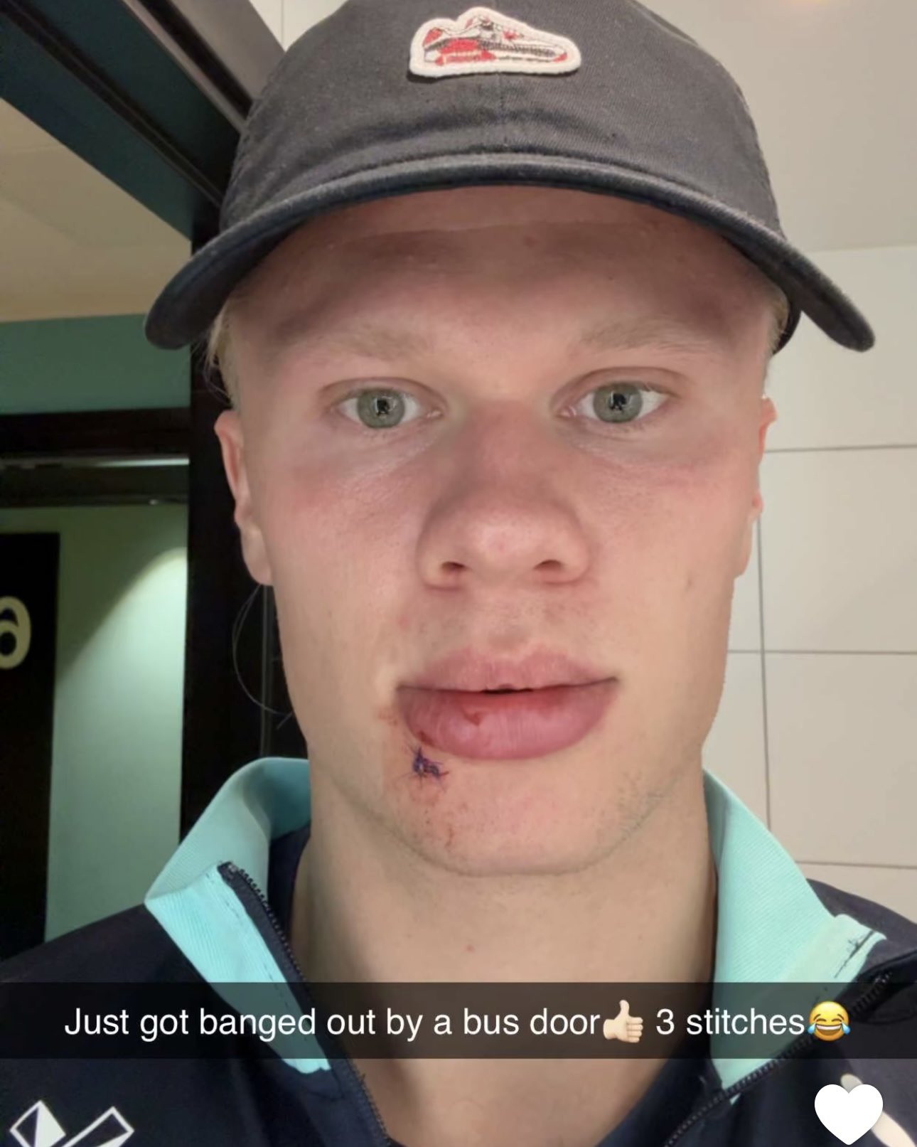 开云体育入口-😂被门夹了？哈兰德晒照：让大巴车门打到嘴，缝了三针